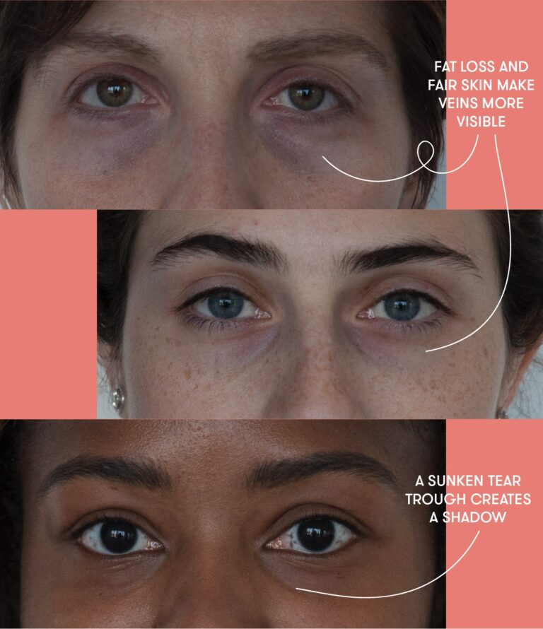 Do dark circles go away?