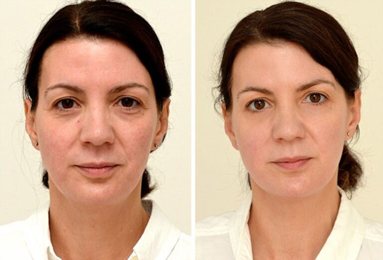 Does drinking water reduce dark circles?