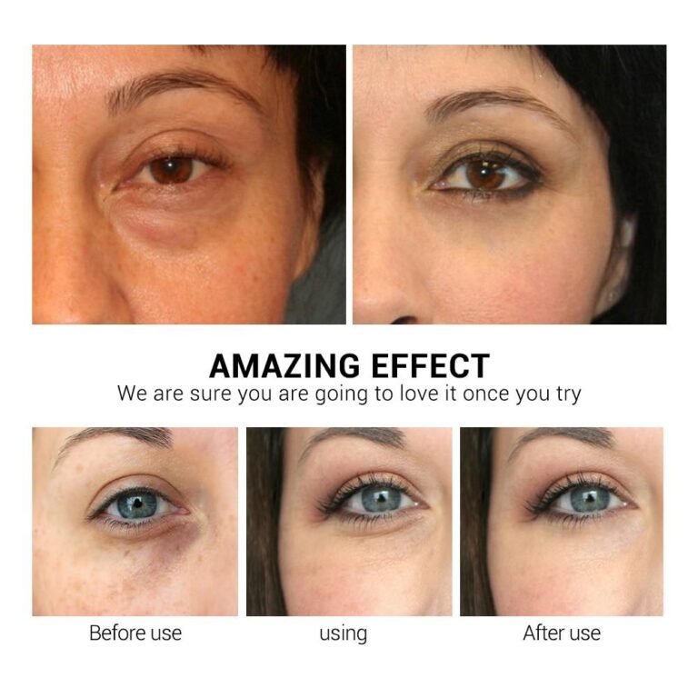 Does vitamin C help dark circles?