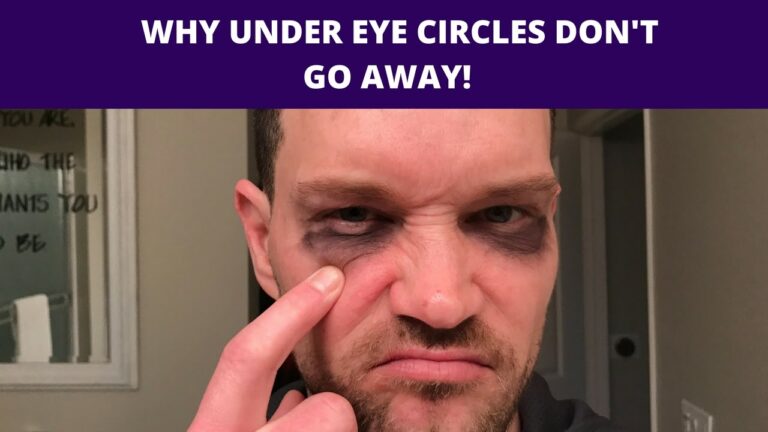 Why are my dark circles not going away?
