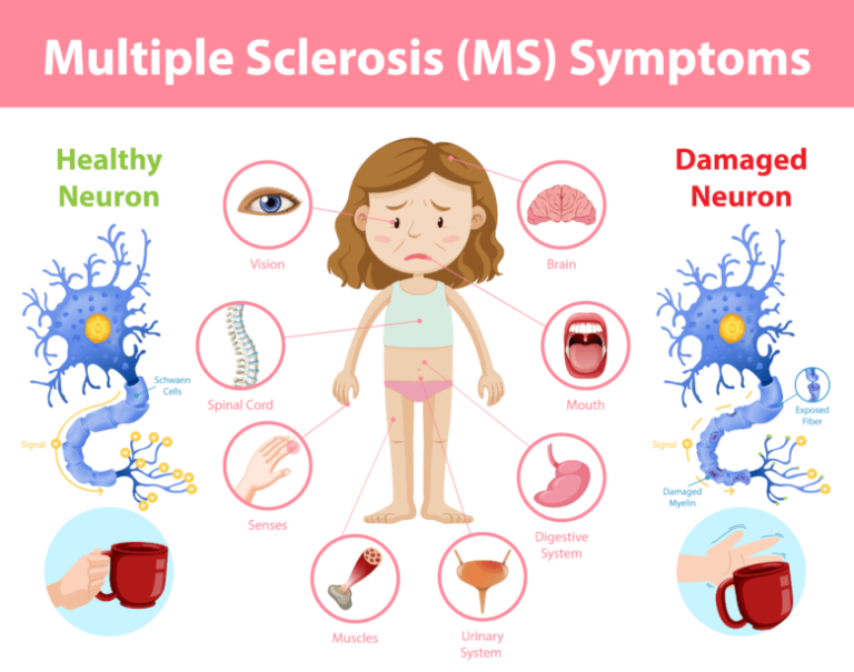 Can MS symptoms be brought on by stress?