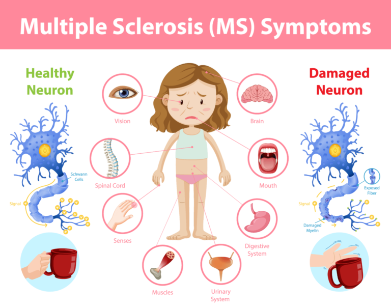 Is MS triggered by stress?