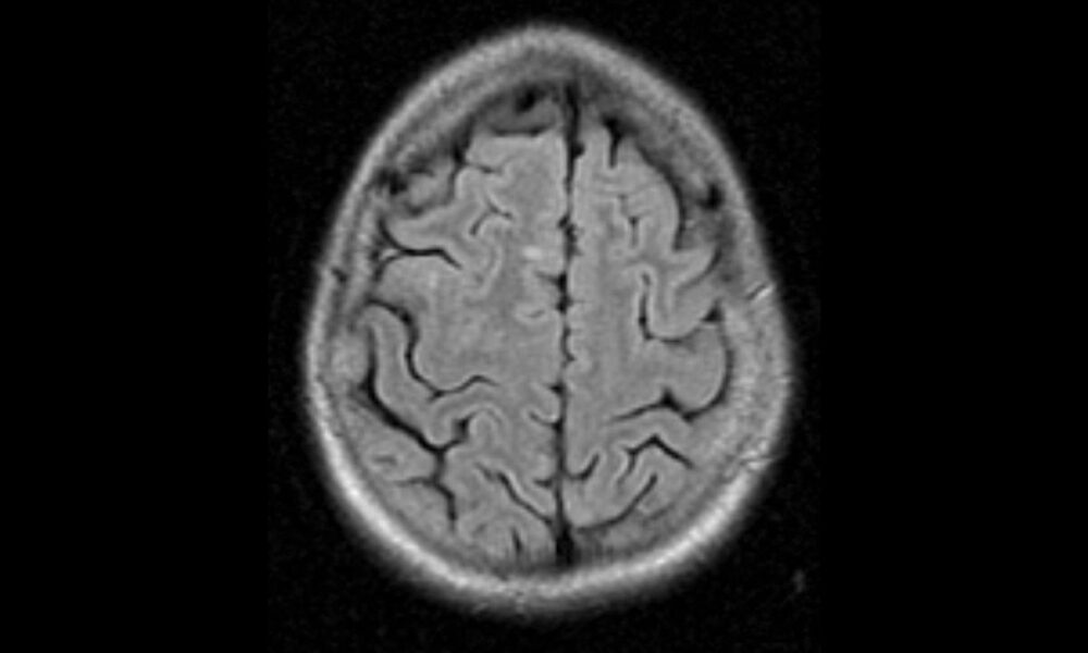 What happens when MS lesions disappear? TechDIY.info