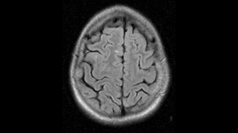 What happens when MS lesions disappear?